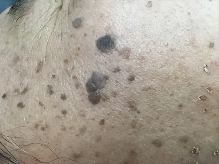 老年斑和色素沉着怎么区分,老年斑和色素沉着怎么治