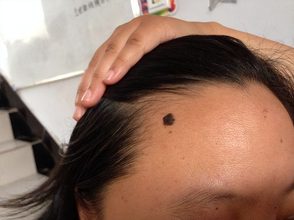 黑痣长在脸上各部位代表什么图片,医生说黑痣有癌变的可能怎么办