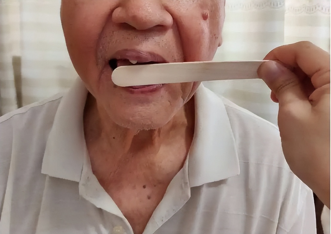 中风并发症会增加病死率，中医特色疗法针灸治疗效果如何？