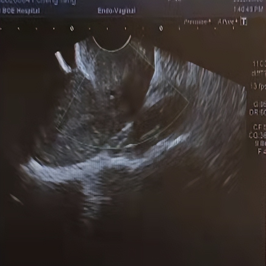 卵巢囊肿微创手术术后没插引流管,腹腔镜下卵巢囊肿切除术的步骤