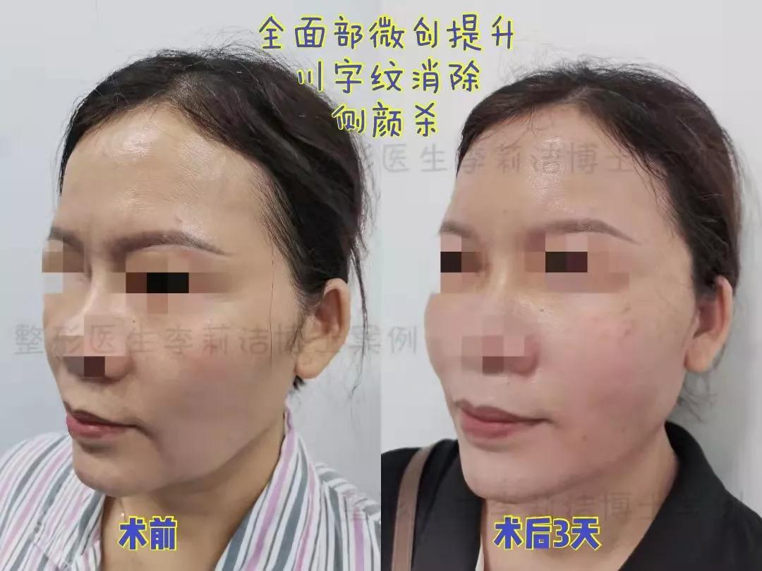 刚做的线雕,刚做线雕后脸上有凹陷正常吗