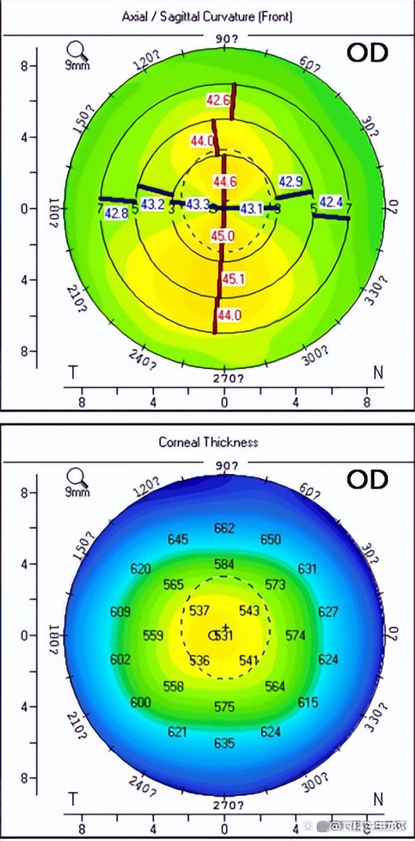 度数低角膜薄适合做哪种近视手术,角膜薄度数高能做近视手术吗