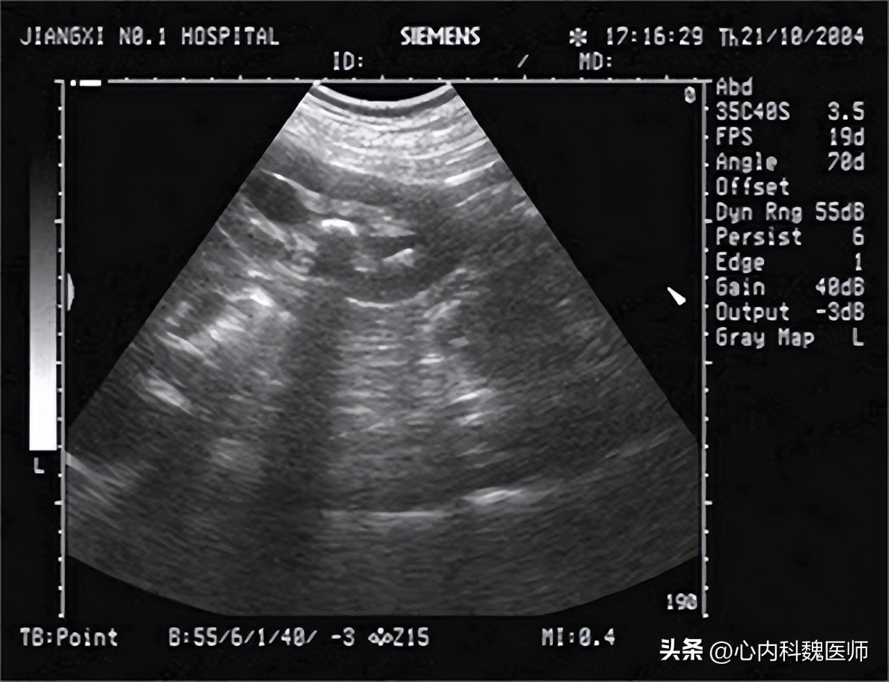 65岁老人常年吃氨氯地平，擅自换药肾衰竭！这些降压药知识需清楚