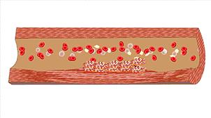 图解血管堵塞全过程，三氧疗法保持血管“年轻态”！