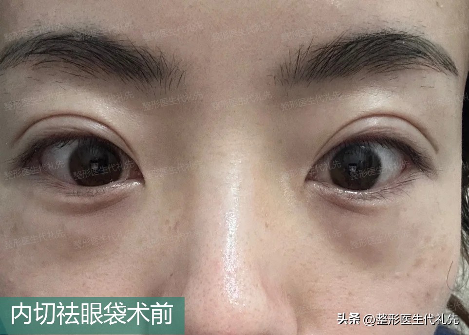 眼袋内切手术后眼袋不对称,年轻人内切眼袋手术恢复期7天图
