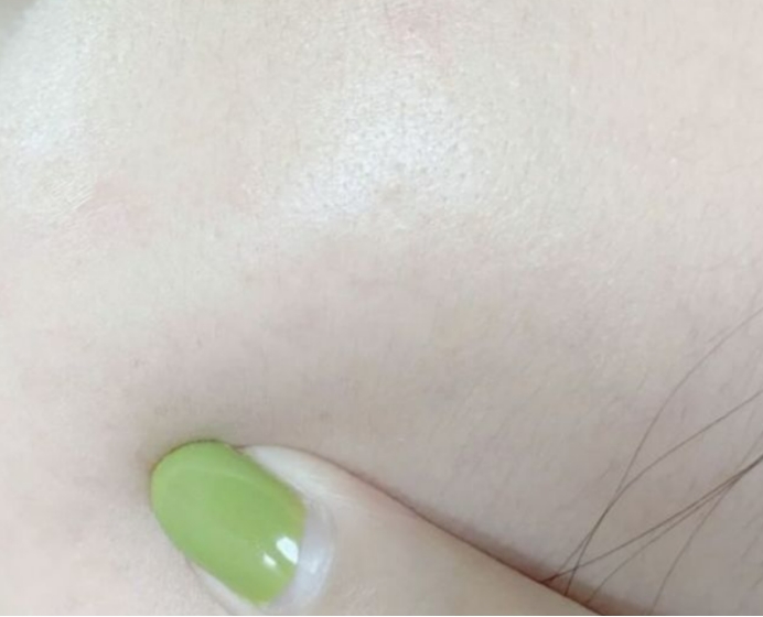 孕期长痘适合用的水乳,孕妇有闭口适合用的水乳有哪些