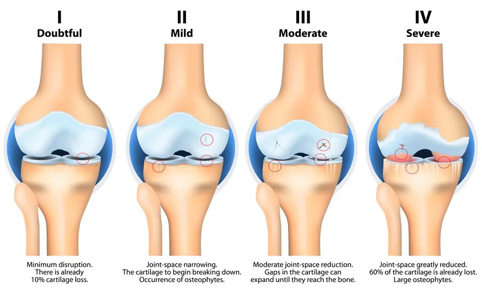 膝关节炎的保健与自我治疗,膝关节炎的保膝治疗