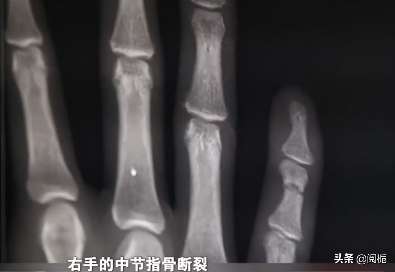 小伙子受伤却不愿去医院后续,小伙因车祸致残