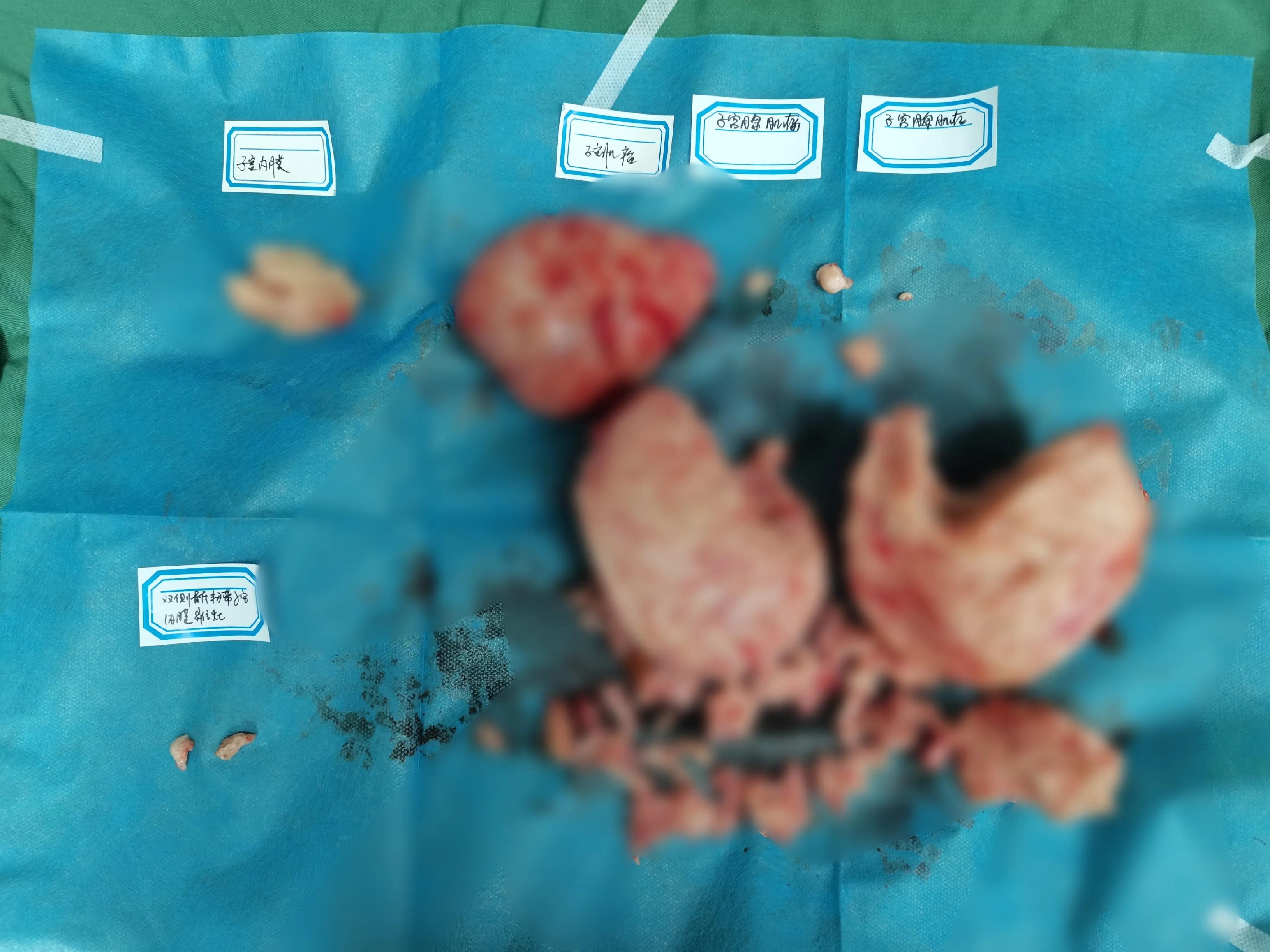 来自浙江的张女士，49岁，深受腺肌症折磨14年