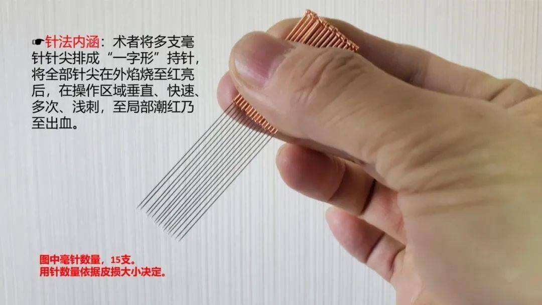 带状疱疹针挑疗法,带状疱疹针刺选穴