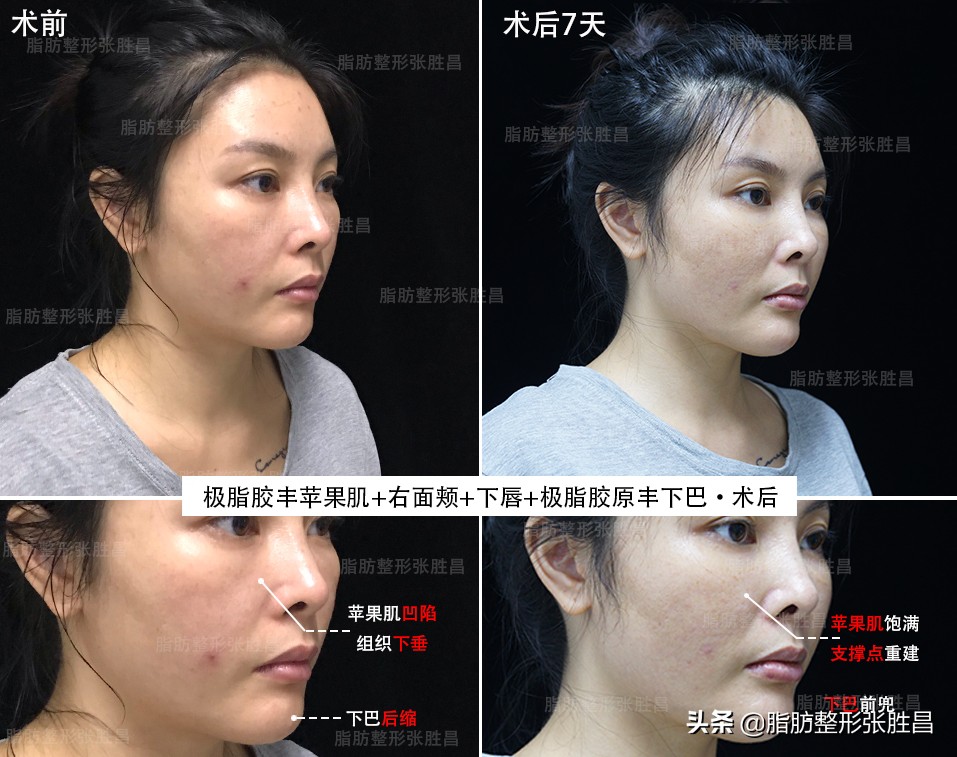 自体脂肪填充丰胸缺点,自身脂肪填充脸部有什么缺点