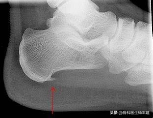 中老年人脚后跟疼是腕管综合征吗,中老年人脚后跟疼痛图片