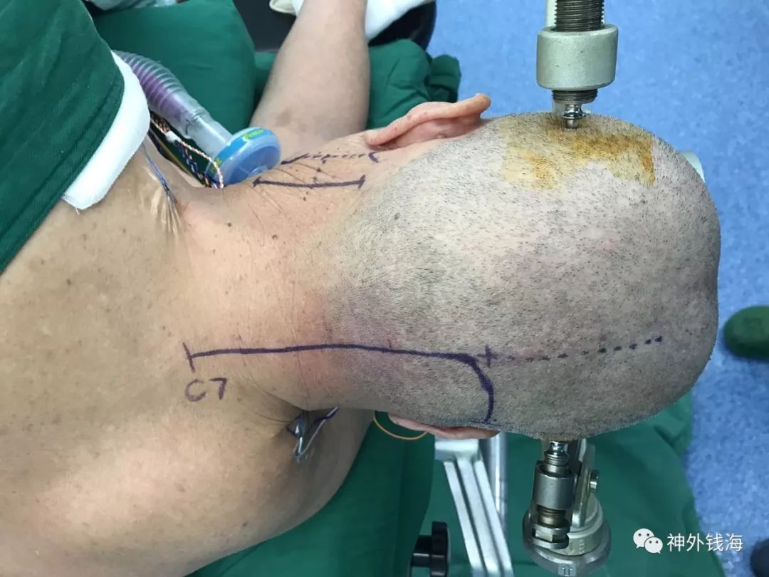 “歪脖子”是种病,需要手术治疗