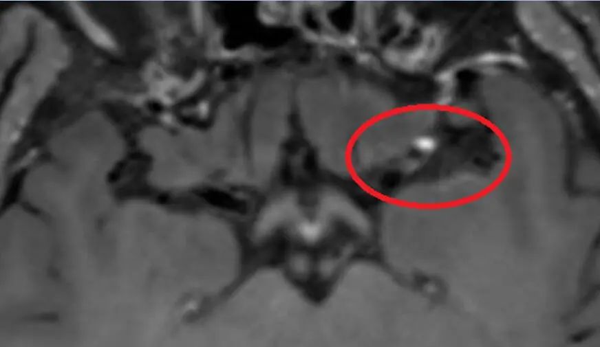 首创国内ICAS多模态评估体系开创脑血管领域精准诊疗新纪元