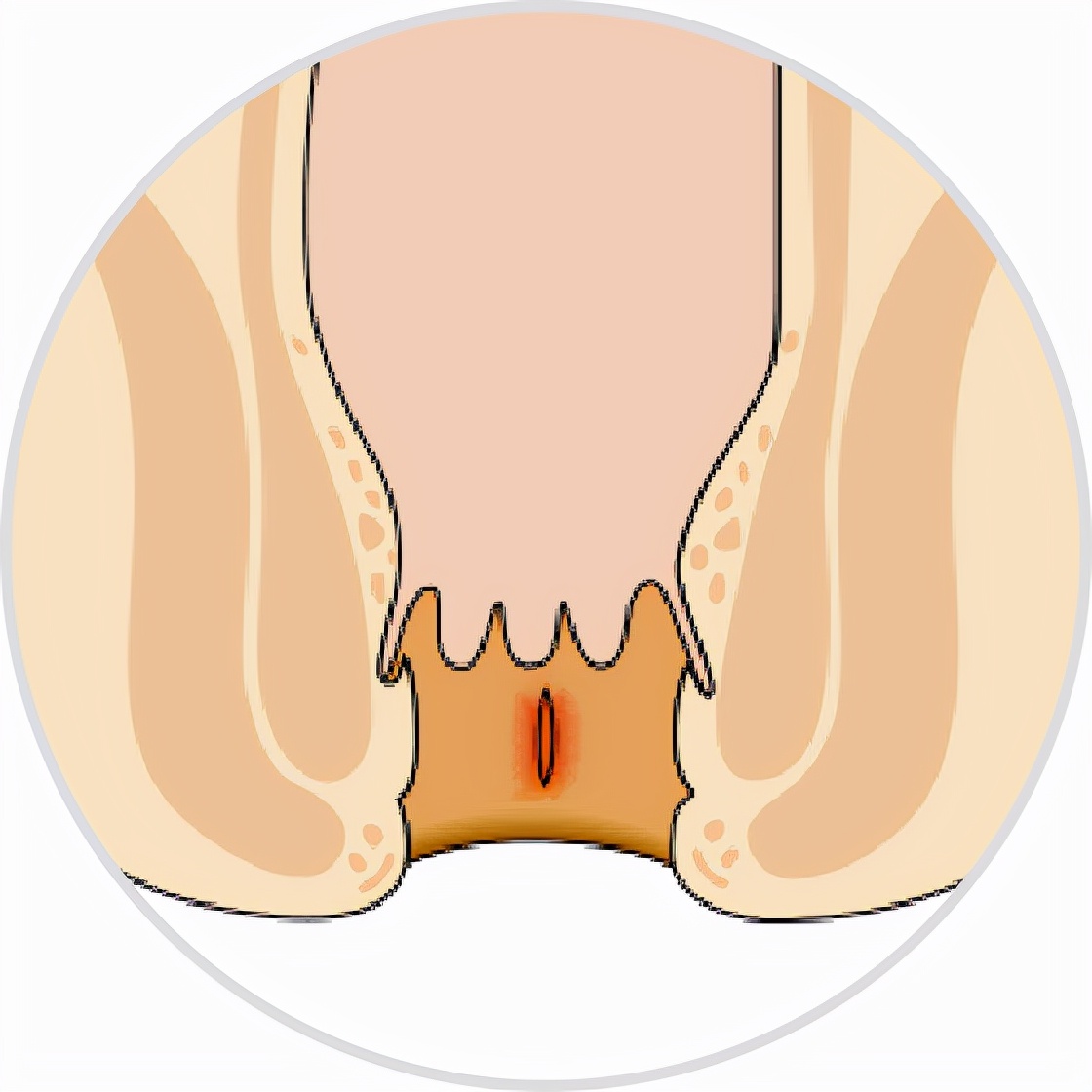 肛裂溃疡面的特征,肛裂的特征