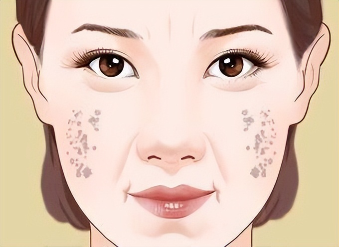 红霉素祛老年斑最有效的偏方,祛老年斑小妙招红霉素软膏