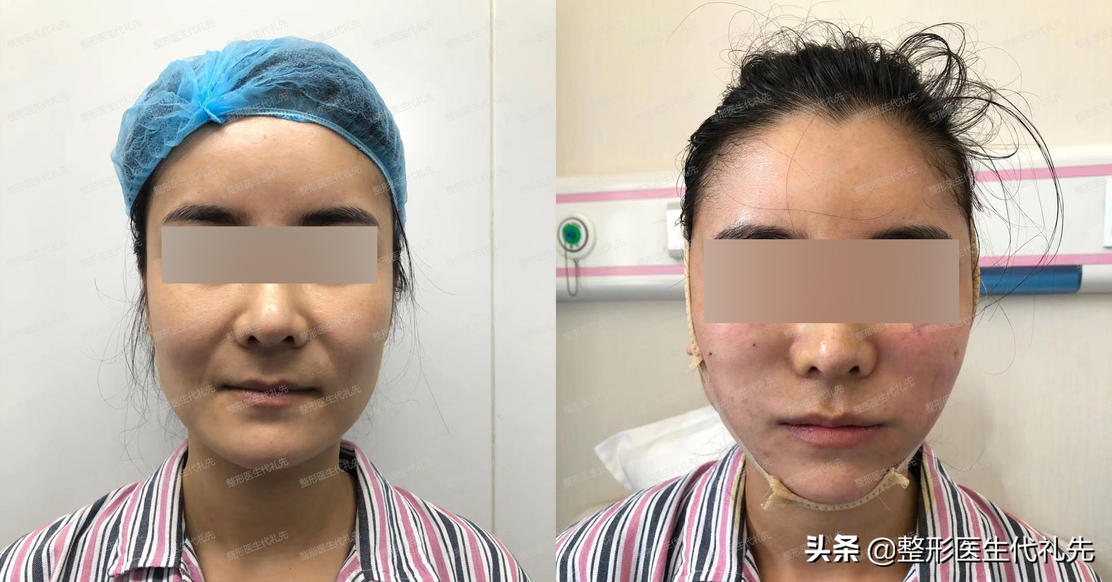 消除法令纹最有效的方法是什么,消除法令纹最好方法视频