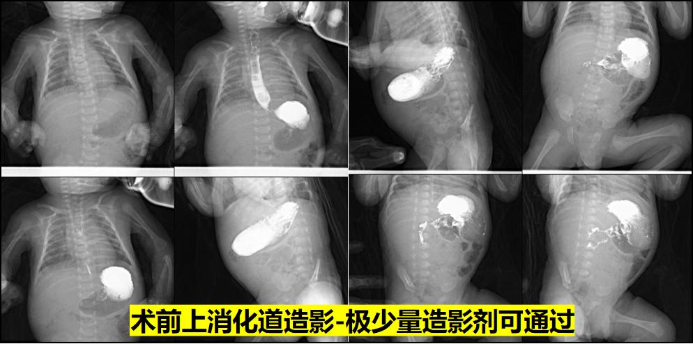 新生儿39天大口吐奶,35天的婴儿吐奶严重