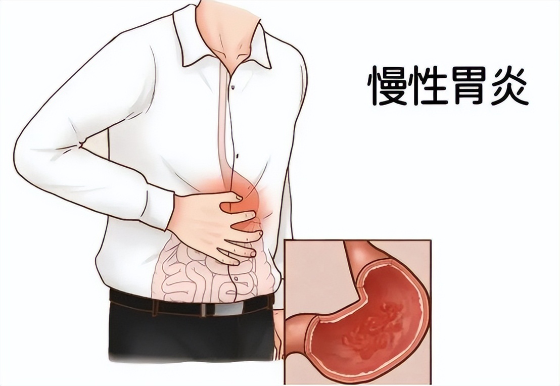 慢性胃炎中医治疗还是西医治疗,慢性胃炎的中医药诊疗方法有哪些