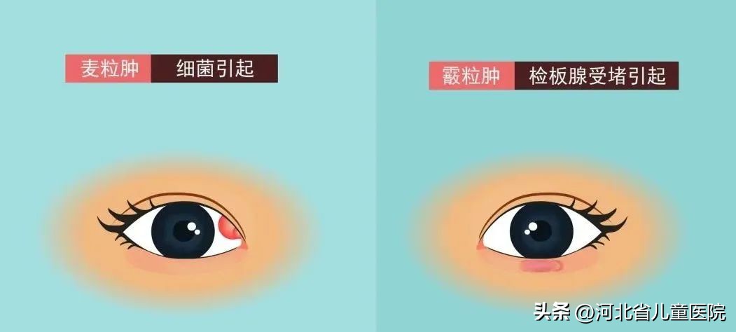 霰粒肿如何避免复发,霰粒肿科普文章