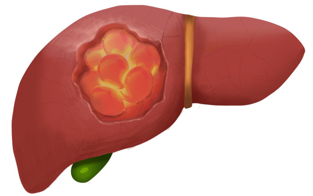 怎样预防癌的发生,预防癌症和肿瘤饮食上注意什么
