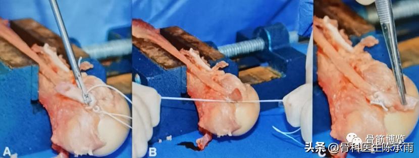 肱二头肌长头肌腱断裂超声报告,上臂肱二头肌