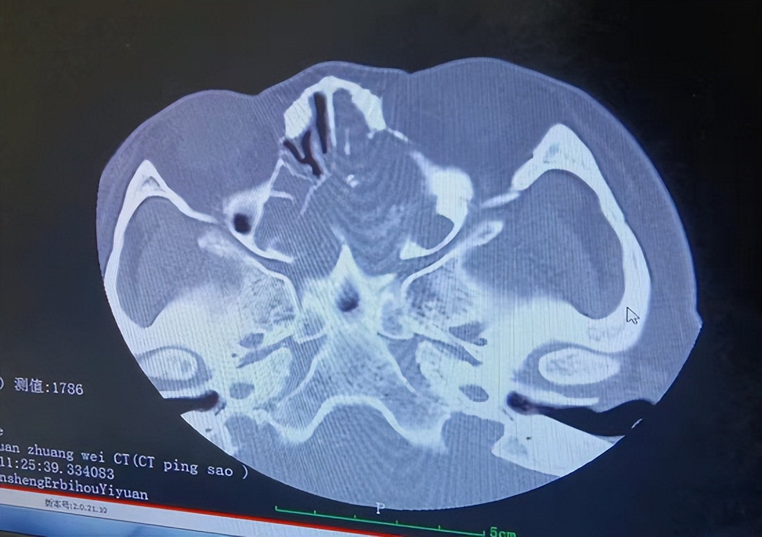 66岁患者头痛鼻塞三年多，不是感冒而是霉菌在鼻子里安了家