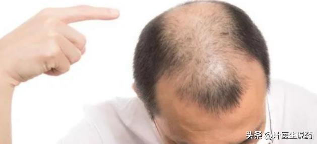 头顶开始变秃了怎么办,头顶越来越秃需要剪短吗