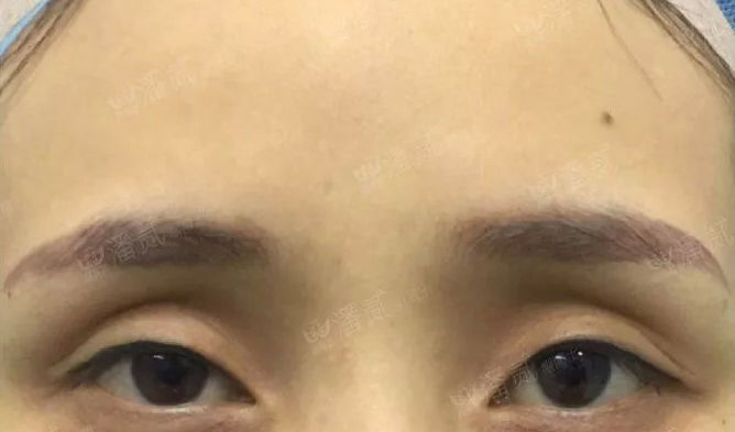 眼窝凹陷是什么症状,眼窝凹陷的改善方法有哪些