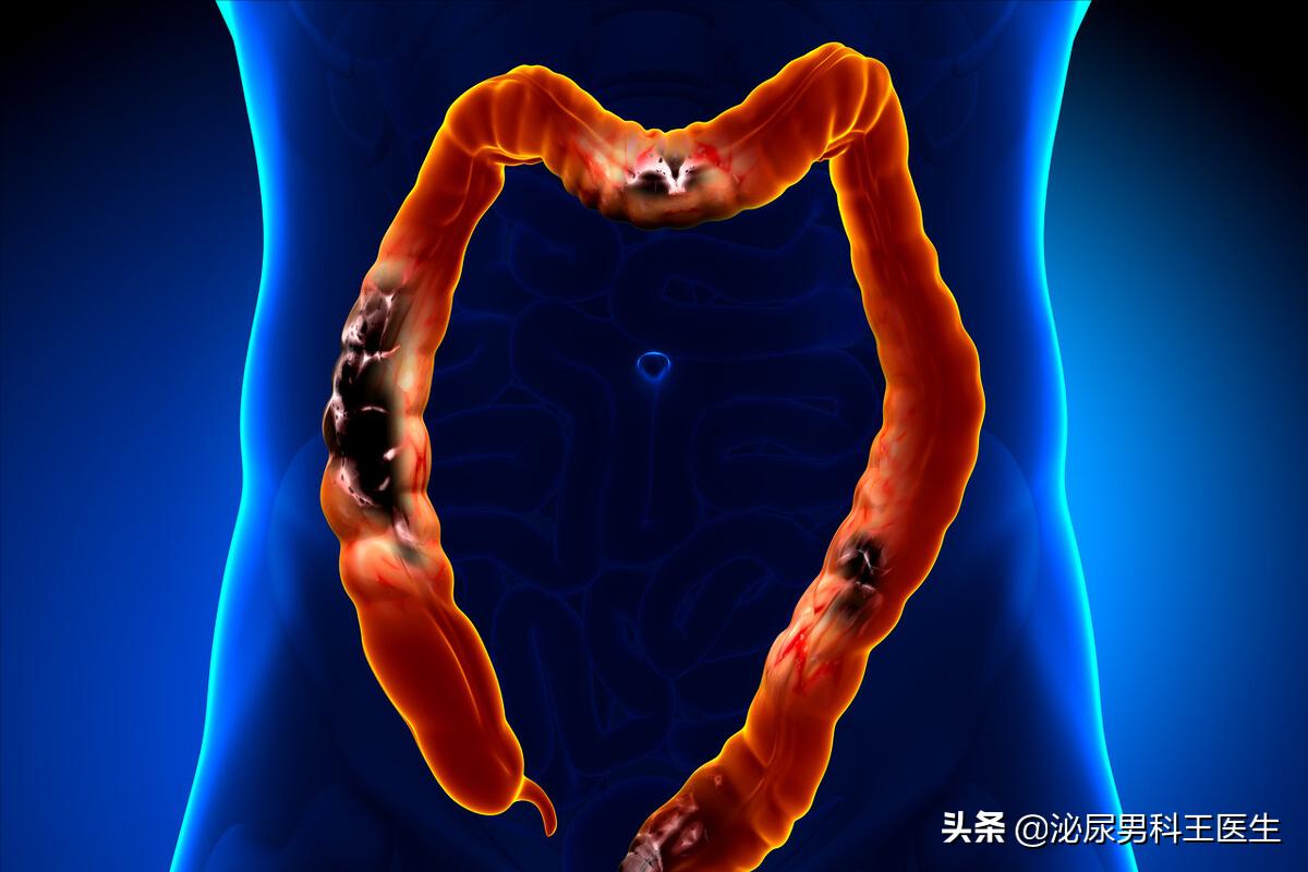 直肠癌的6个早期症状是一起出现,直肠癌出现便秘早期还是晚期