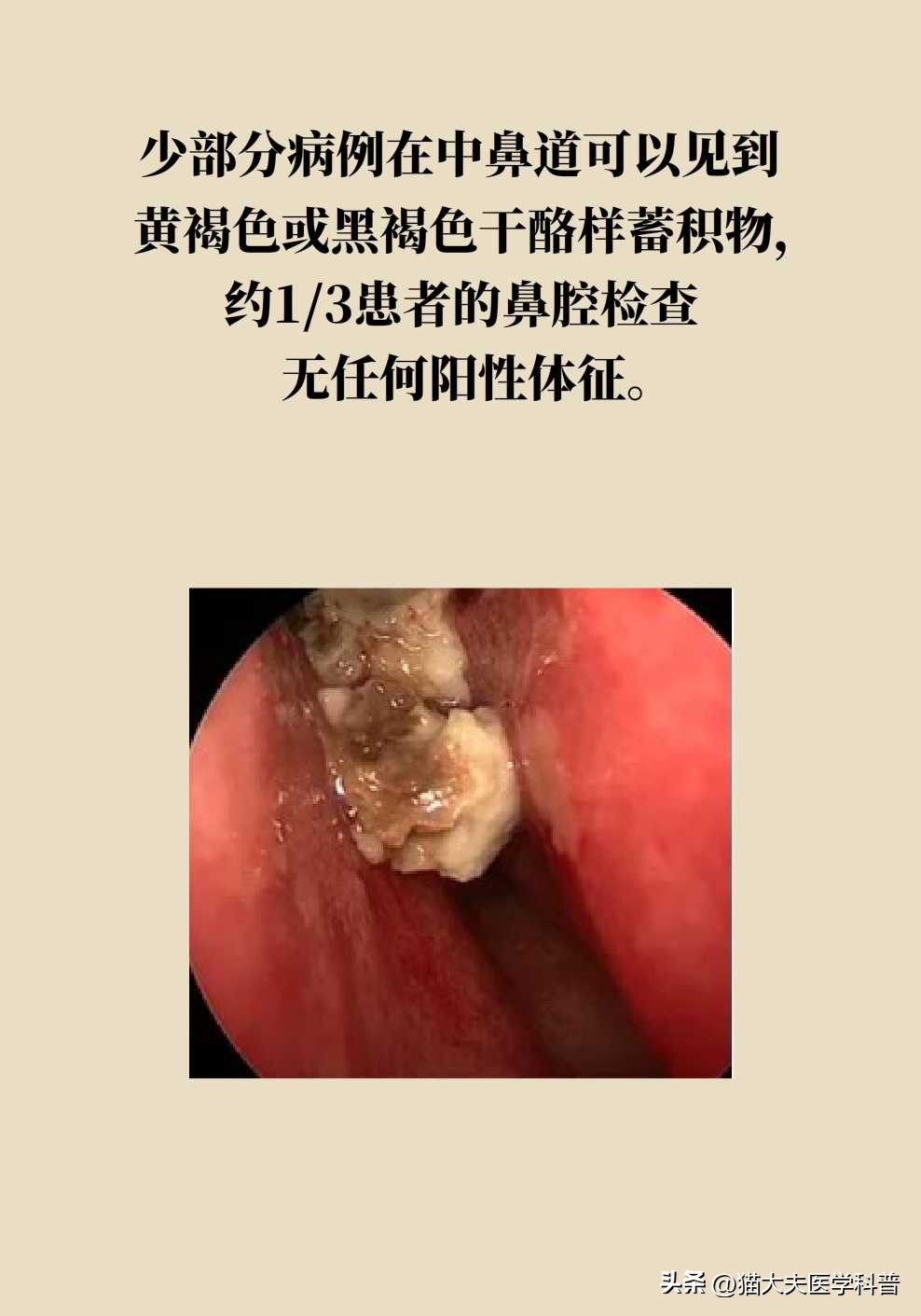 霉菌长什么样,鼻子里的霉菌图片