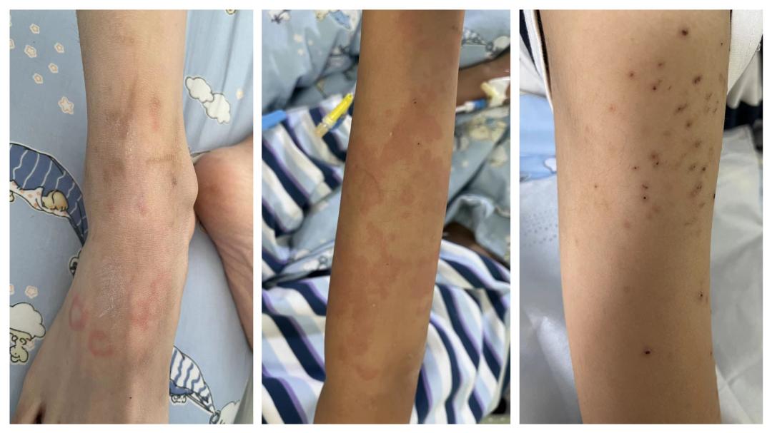 西安大兴医院：血管炎+“马蹄肾”，一场14岁少年的跨省救援