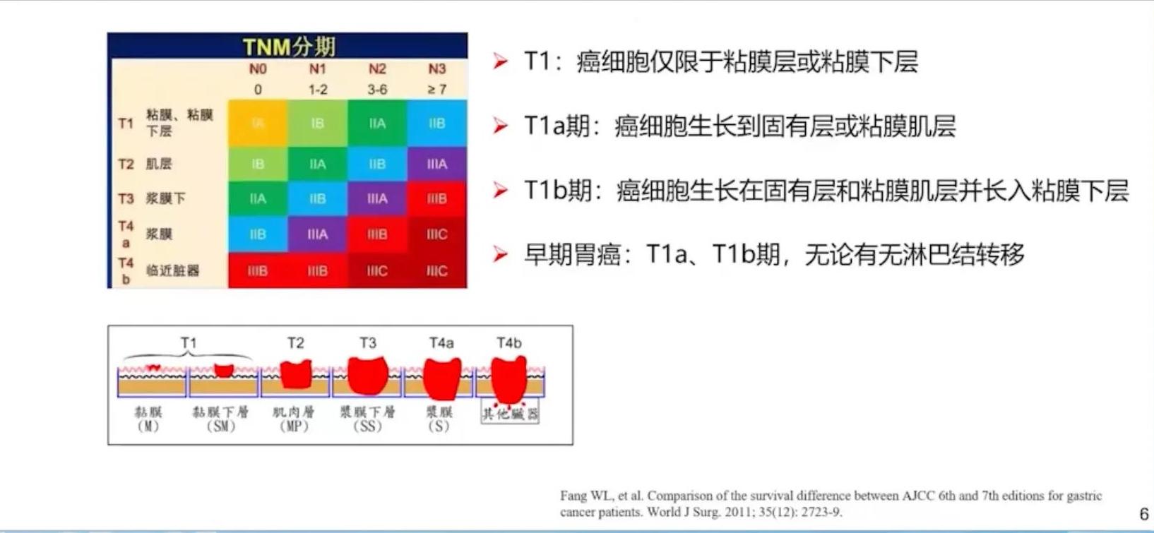 胃早癌食管早癌会复发吗,胃早癌与进展期癌怎么区分