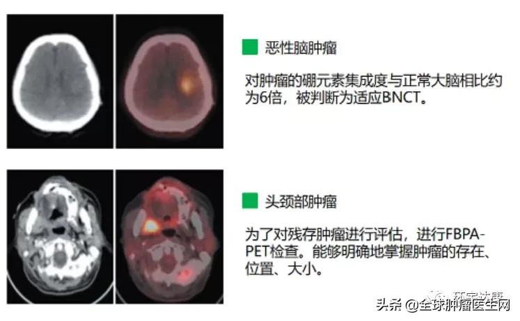 硼中子俘获治疗国内最新进展,国内首台硼中子俘获治疗装置下线