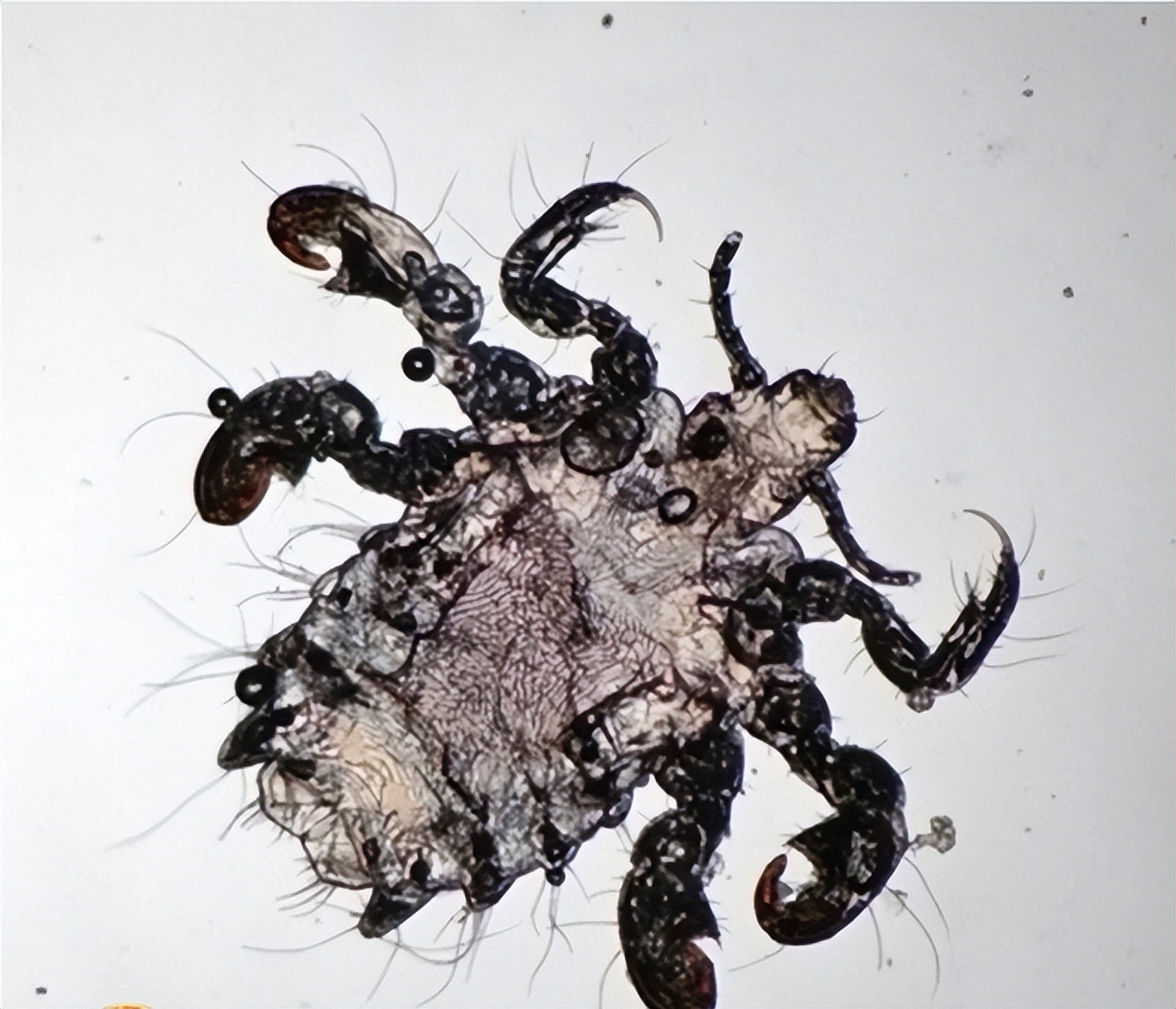 阴虱会传播性疾病吗,阴虱传播哪些疾病