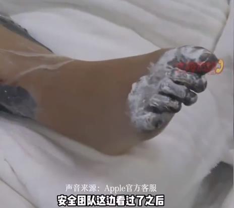 被电击女孩因脏器受损面临截肢,女孩充电时玩手机被电击面临截肢