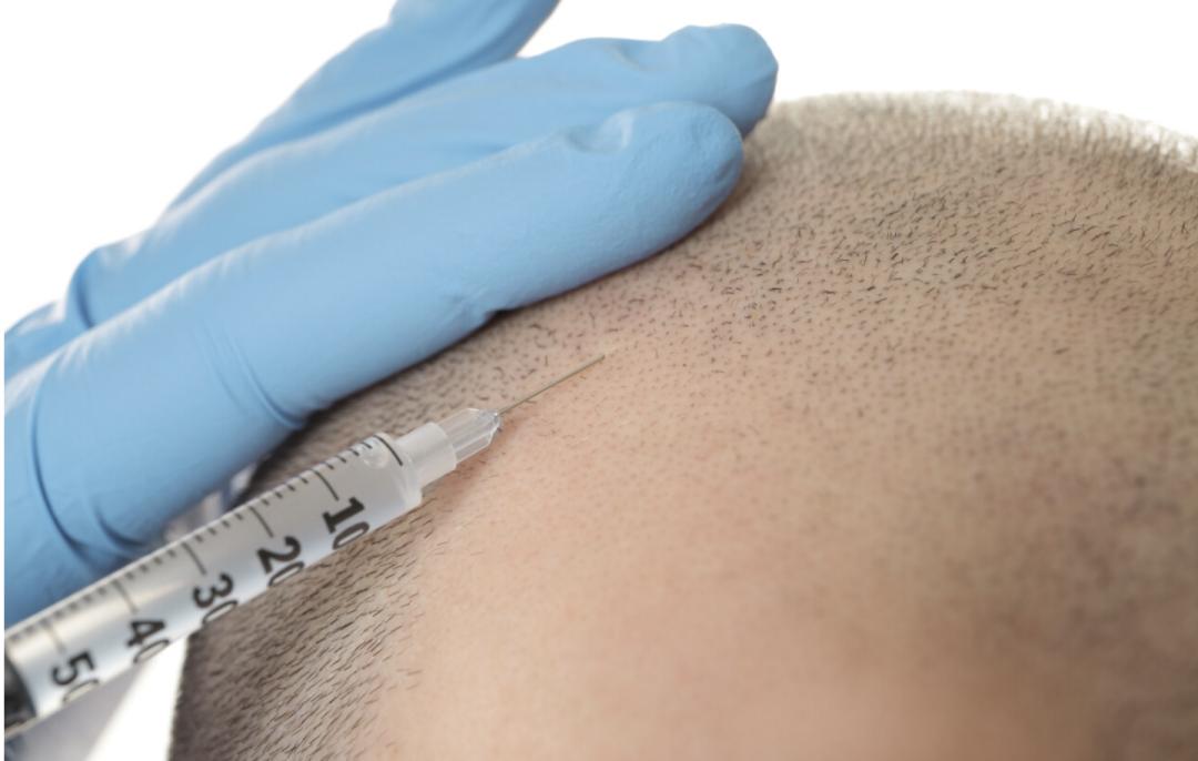 雍禾医疗硬闯深水区，植发焦虑挡不住价格焦虑