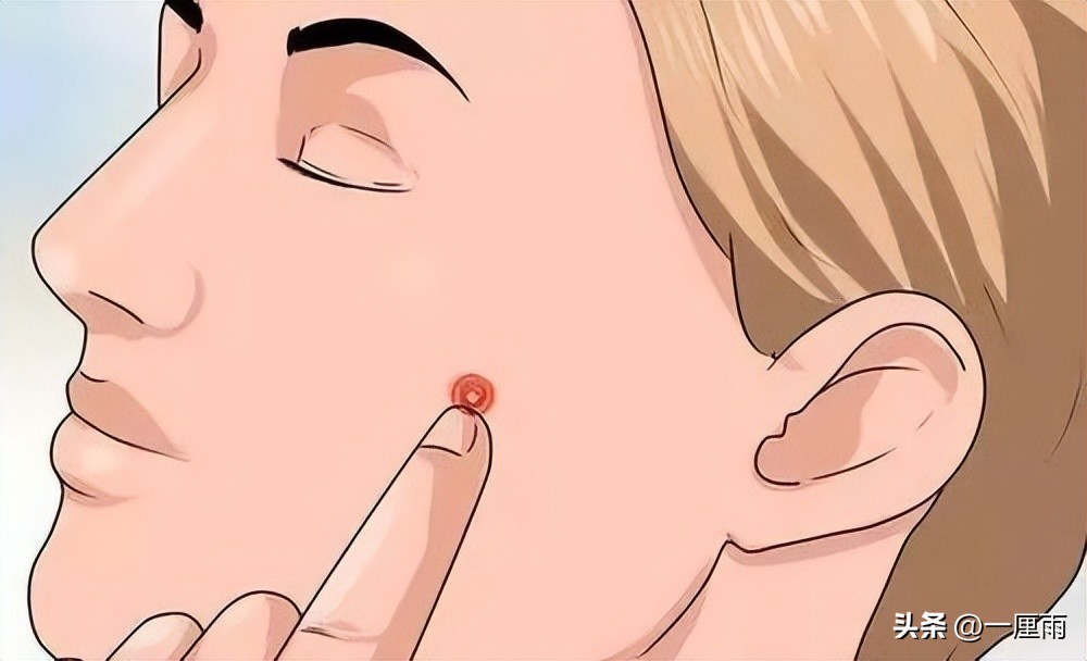 脸上起痘祛痘印的最佳方法,脸上痘痘痘印很严重如何快速祛痘