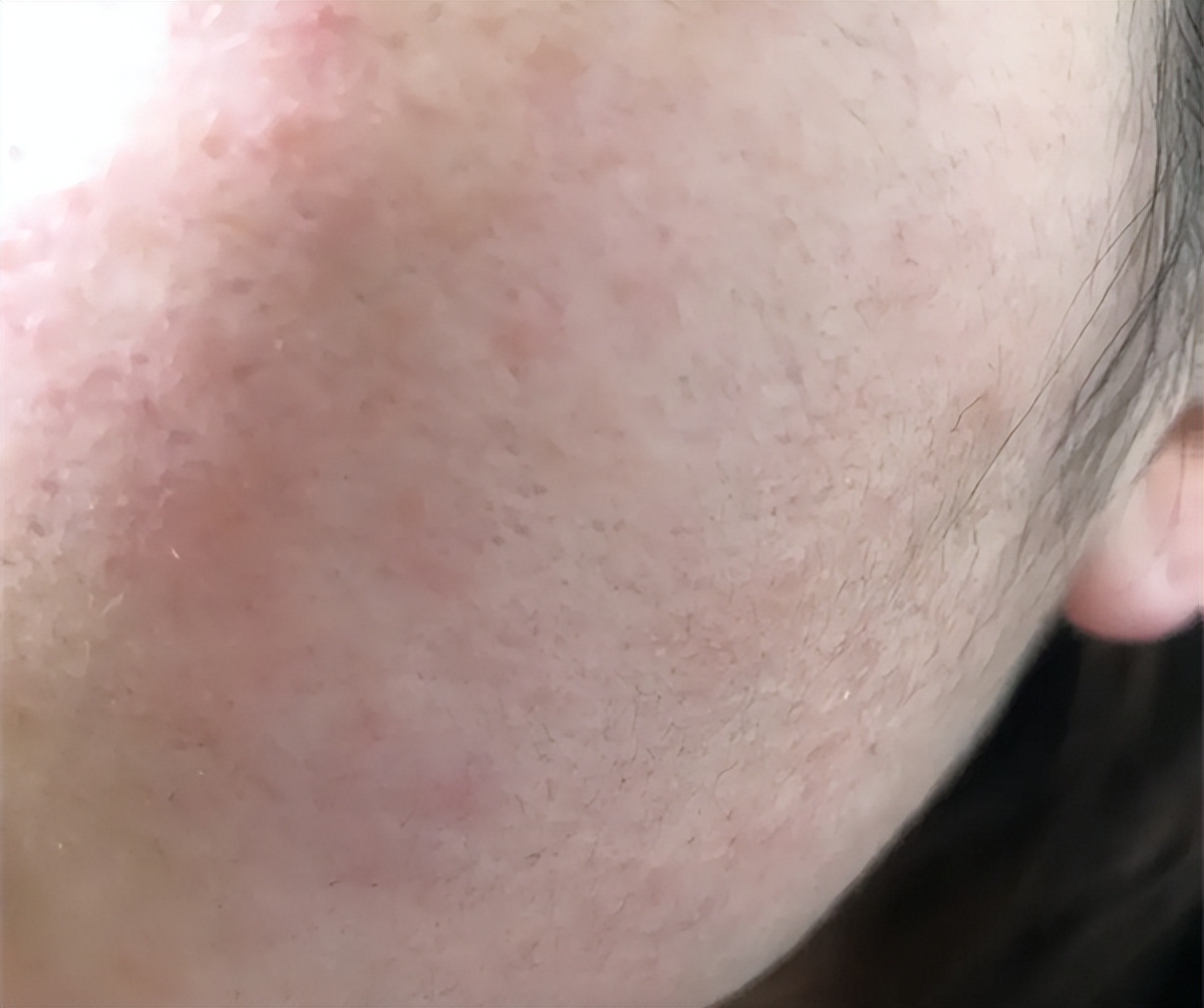 敏感肌应该怎样敷面膜,敷尔佳面膜适合干皮敏感肌用吗