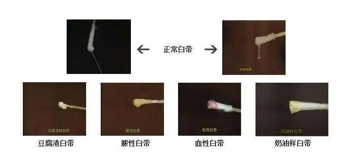 白带异常、外阴痒，难以启齿的阴道炎怎么治？