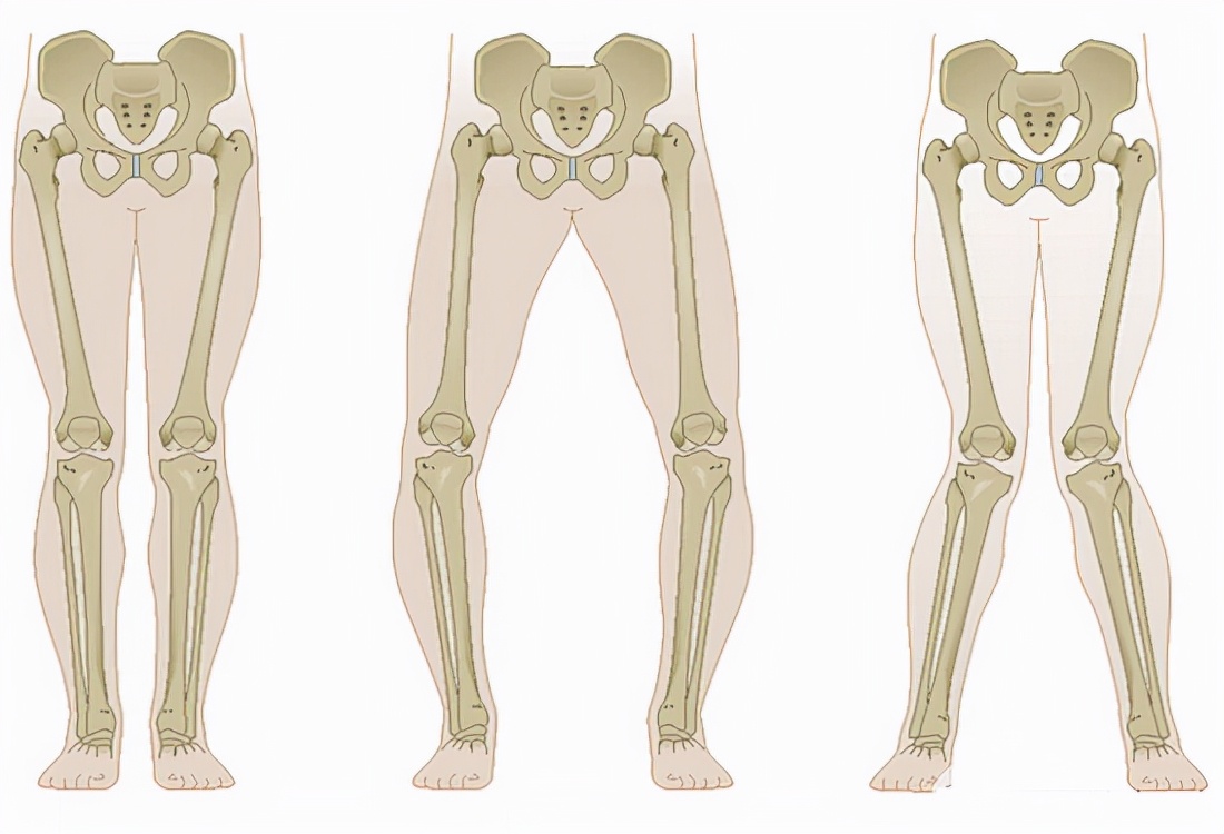为什么会有o型腿,o型腿最有效矫正
