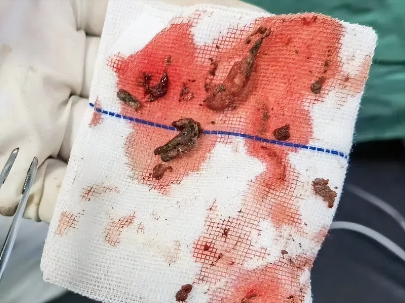 隆回县人民医院:患者身上怪味从何来?原来是“脐膀胱瘘”在作怪