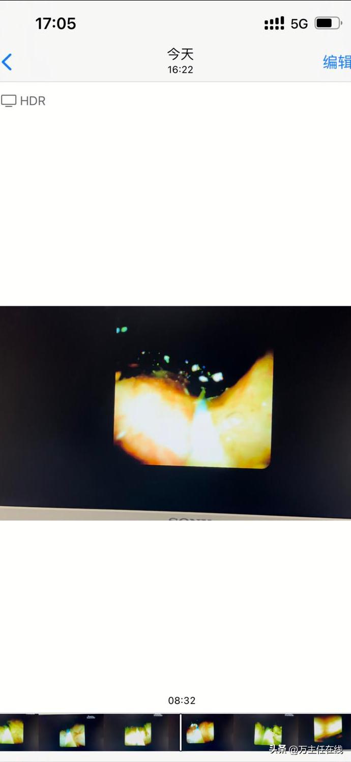 胆结石化脓性胆囊炎,妙手神针巧治疑难杂症