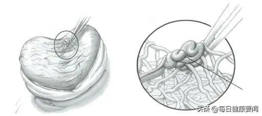 无精症突然又有精子,无精睾丸超声能查出什么问题