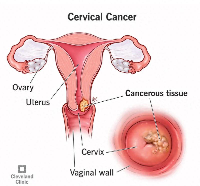 全球最美女人之一去世，仅26岁！曾在中国参加选美比赛，外网悼念