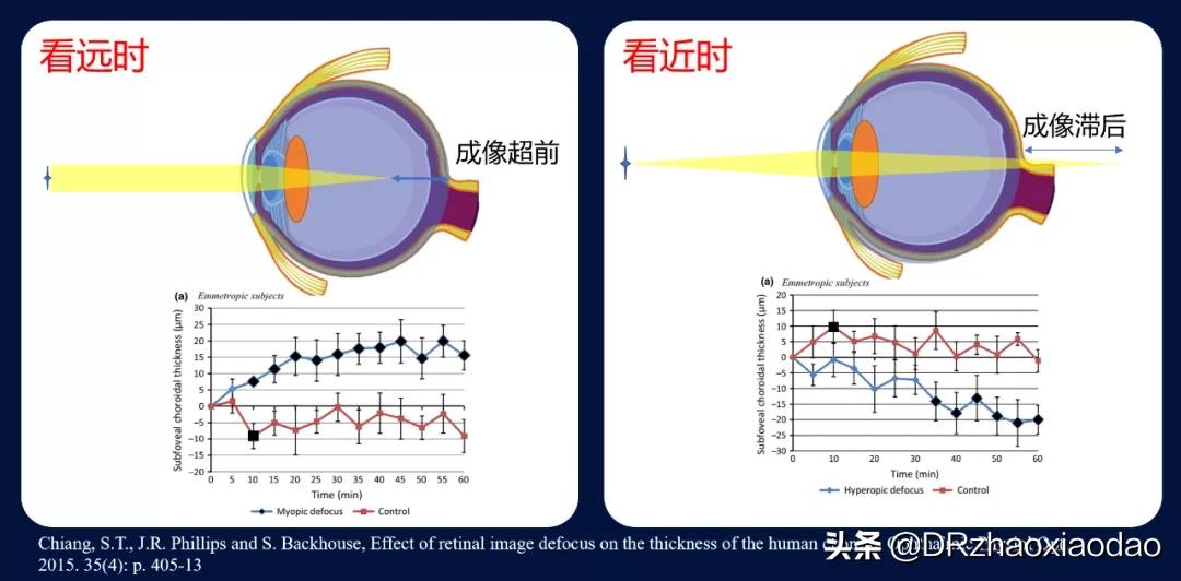 脉络膜增厚怎么解决,脉络膜增厚会怎么样