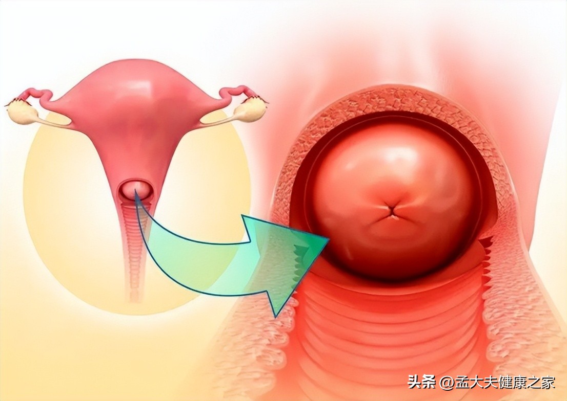 宫颈肥大的原因和危害严重吗,检查宫颈肥大是怎么回事