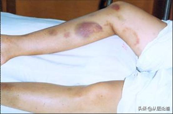 免疫性血小板减少性紫癜itp,血小板减少性紫癜紫斑消失慢