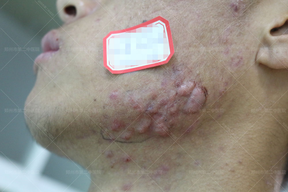 郑州市第一附属人民医院疤痕修复,郑州第二附院疤痕修复价格一览表