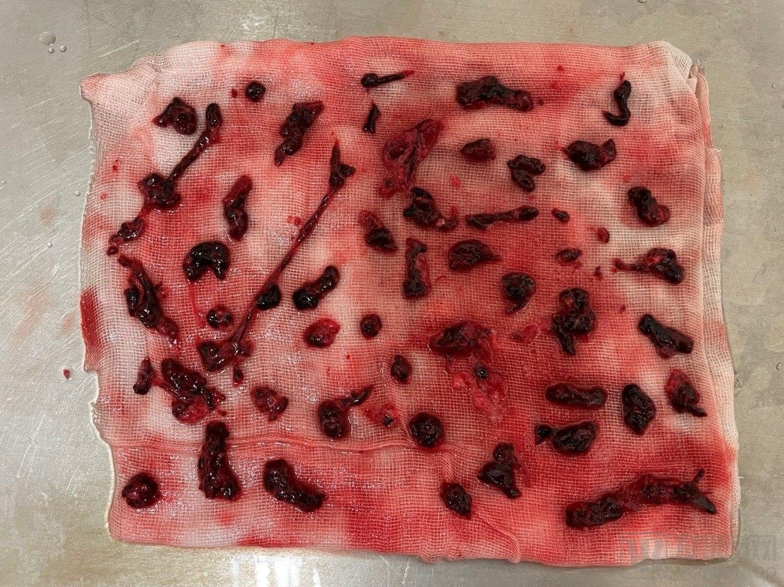 中国医院血栓清除技术,血栓消除的高端技术